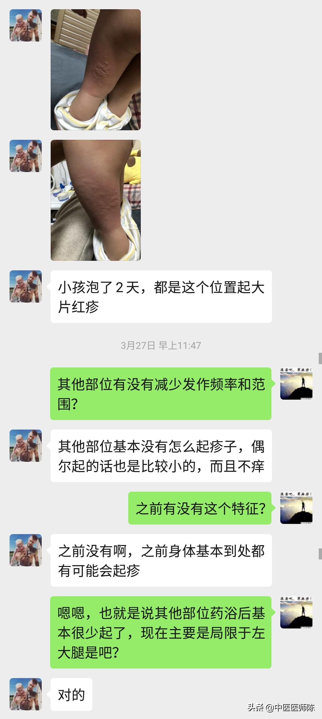 2岁半小儿*麻疹荨**久治不愈中途又发生医患误会，结局不可思议