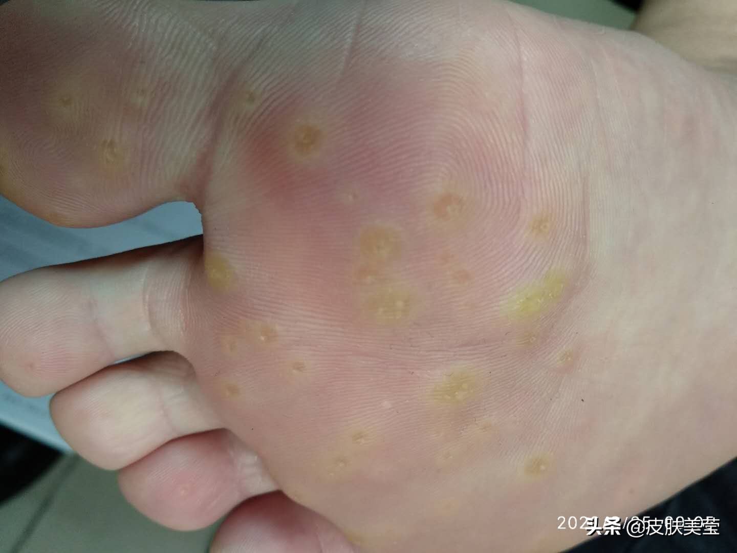 接种hpv疫苗可以预防其他癌症吗,hpv疫苗会让人感染hpv病毒吗