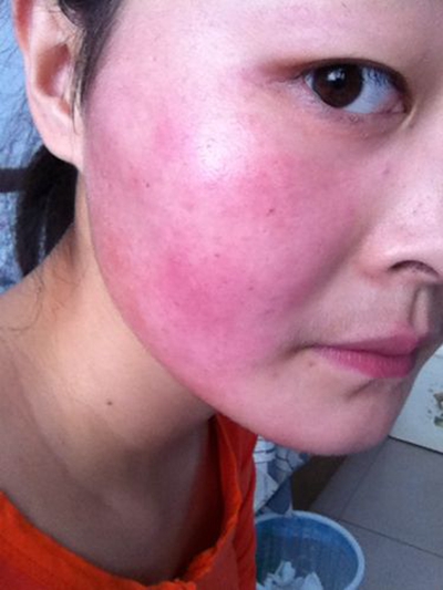 化妆品过敏怎么办脸部发红,化妆品过敏怎么办学生