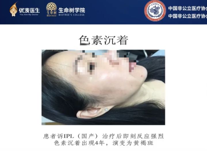 哪种医美项目祛痘印最有效,最有效的医美抗衰项目