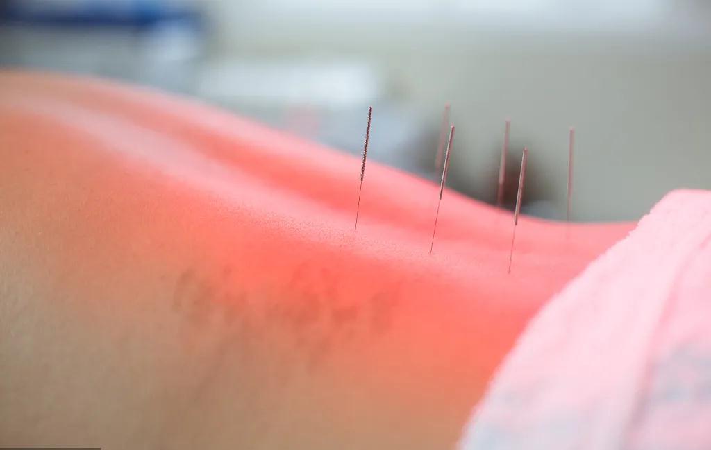 别看小小艾灸不起眼,防治类风湿却有大奇效