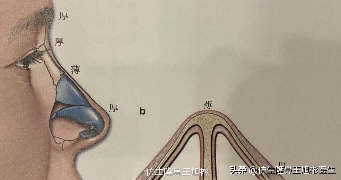 隆鼻的3种常见整形方法,鼻整形隆鼻和鼻综合的区别