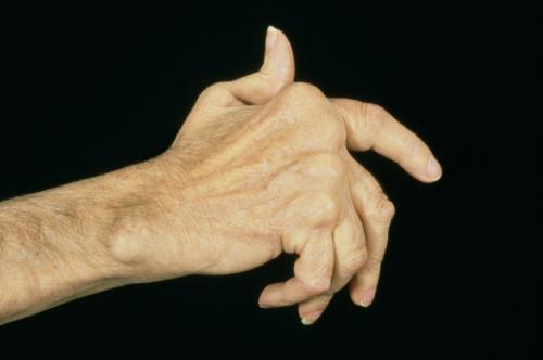 类风湿关节炎保养用什么药,类风湿关节炎有什么症状