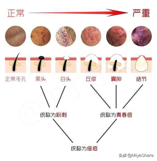 手把手教你去黑头跟黑头说拜拜,日常怎么去黑头和防止黑头