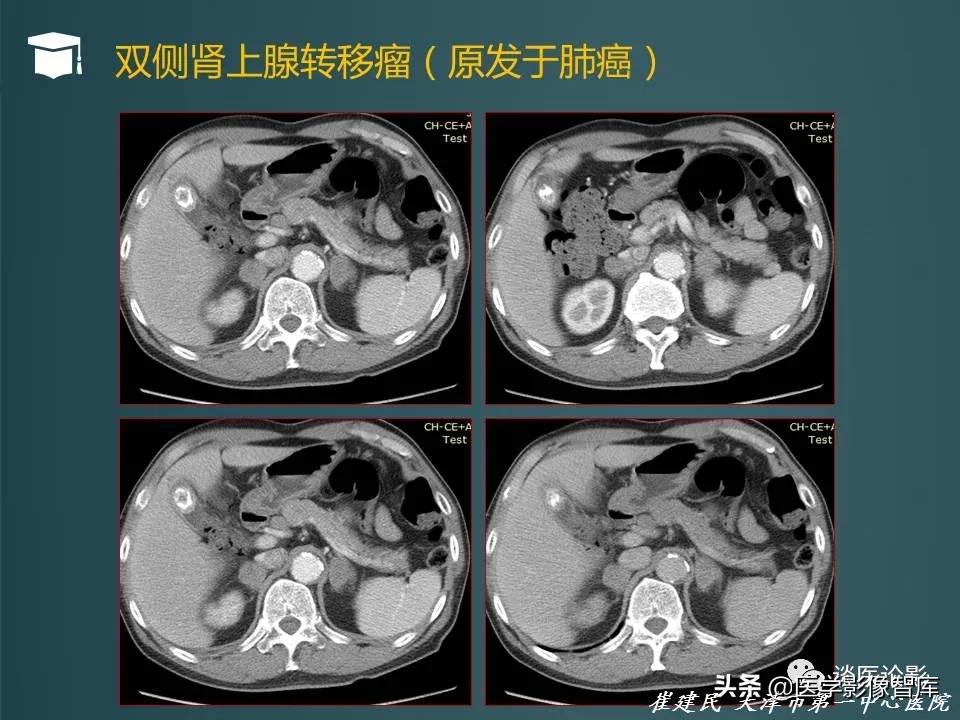 左侧肾上腺结节考虑腺瘤与增生,双侧肾上腺增生是什么原因造成的