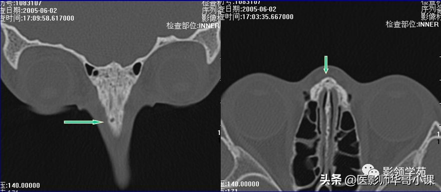 「鼻骨彩图」鼻骨CT解剖及骨折影像学诊断