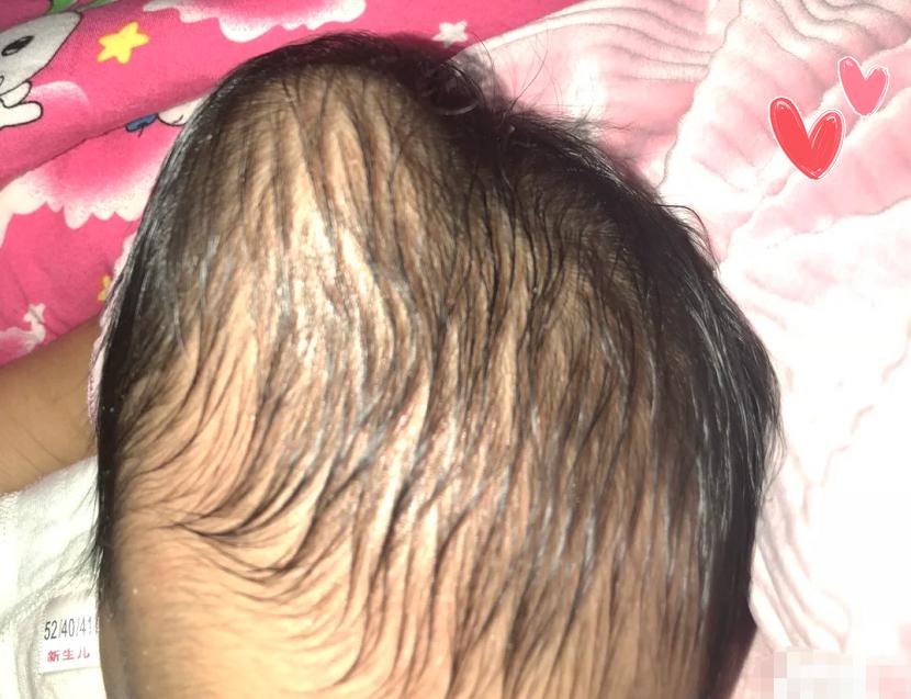 婴儿睡出尖脑瓜怎么办,新生儿脑壳尖