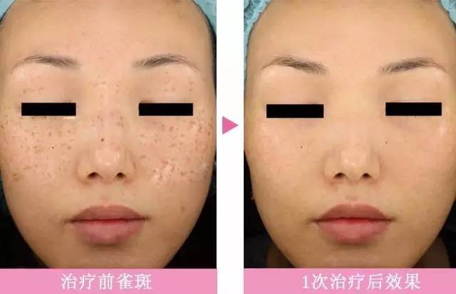 脸上长斑是激光还是用祛斑产品好,50岁年龄脸上长斑怎样能祛斑