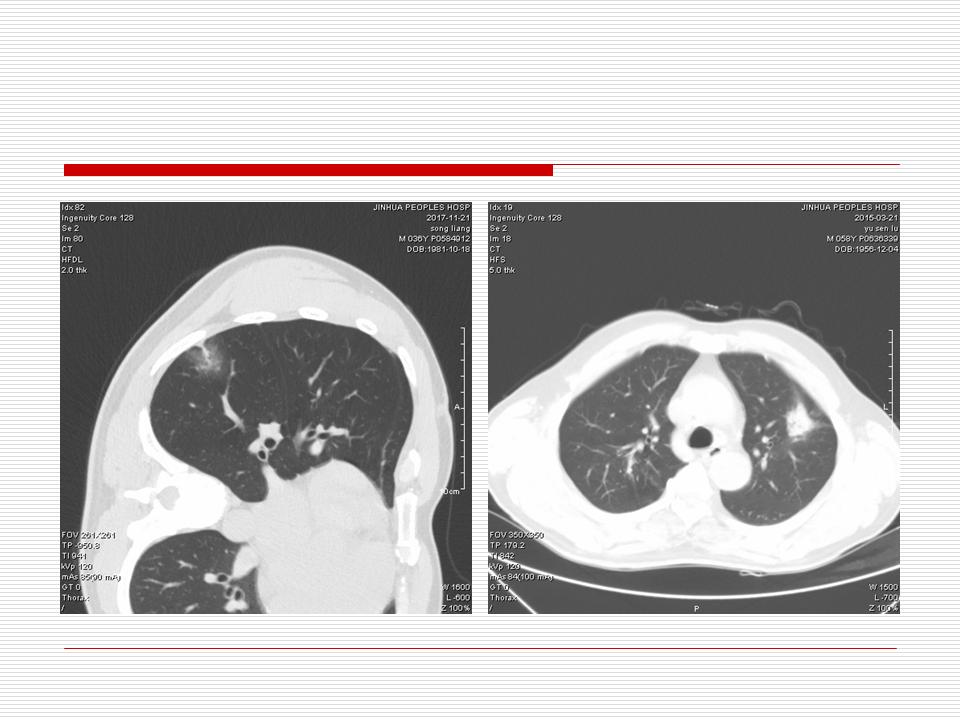 像炎症的肺癌能治好吗,医生说可能是肺癌也可能是炎症