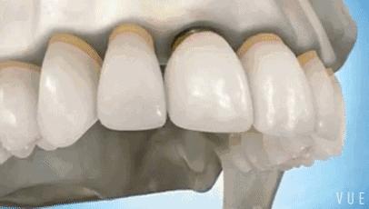 湖北种植牙齿多少钱一个,最新武汉种植牙齿多少钱一颗