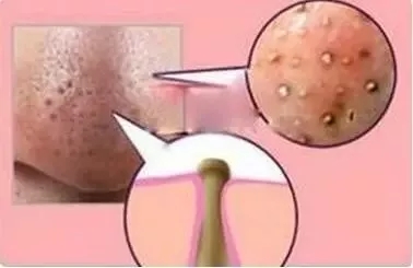 闭口性粉刺怎么去除,闭口性粉刺怎么去除最快