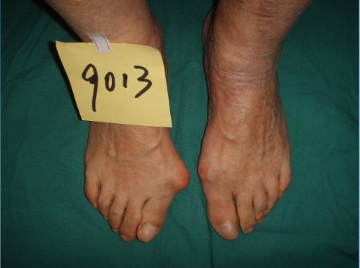 真实的重度大脚骨矫正案例,哈尔滨做大脚骨手术