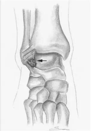 踝关节撞击症问诊,踝关节撞击综合征的x线表现
