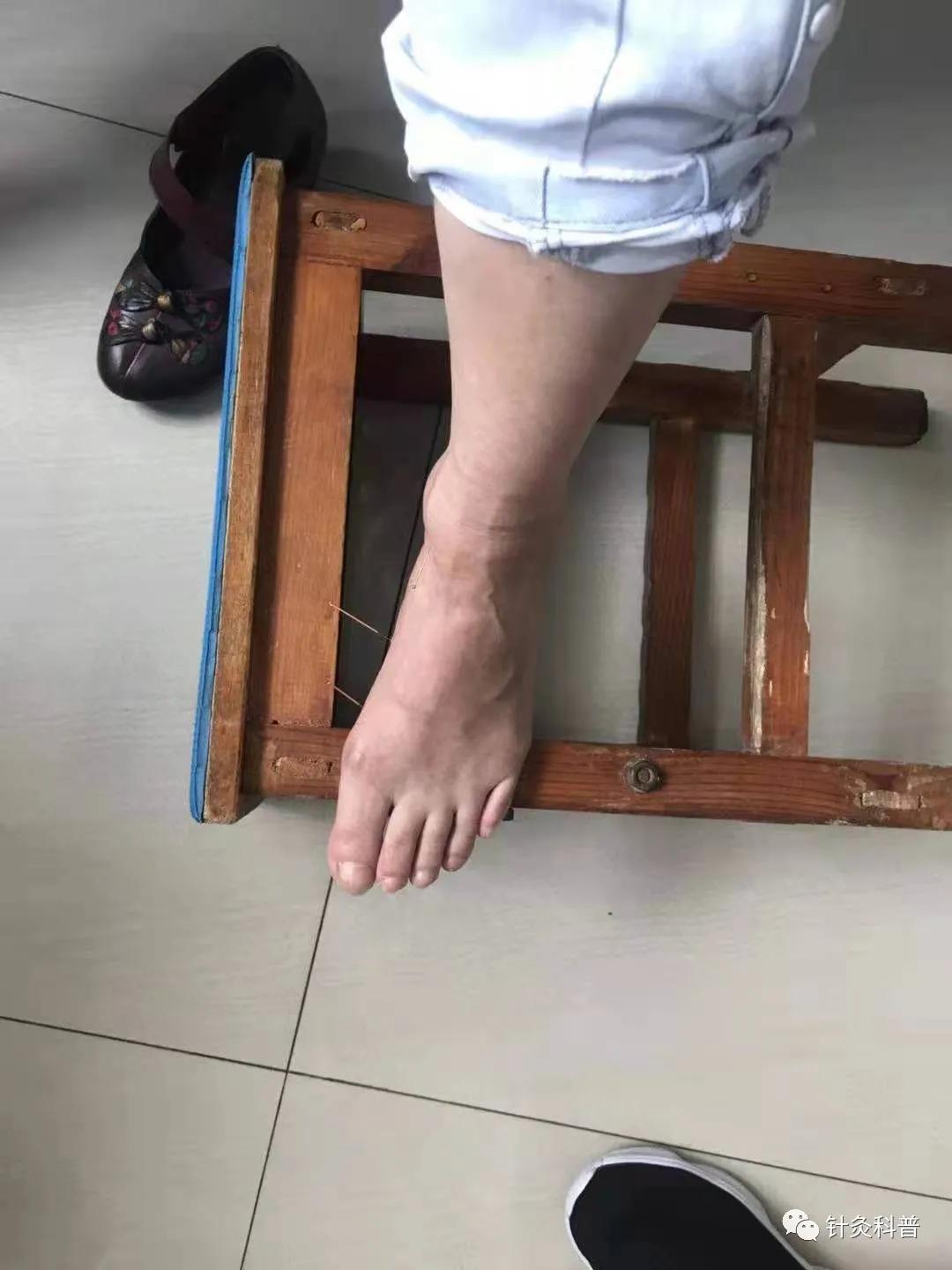 针灸最新疗法300例,传统针灸治疗杂病