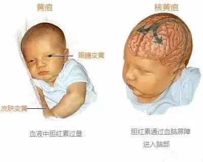 黄疸治疗不及时，宝宝居然会脑瘫？