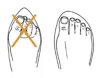 糖尿病足负压护理及观察要点,糖尿病足居家护理