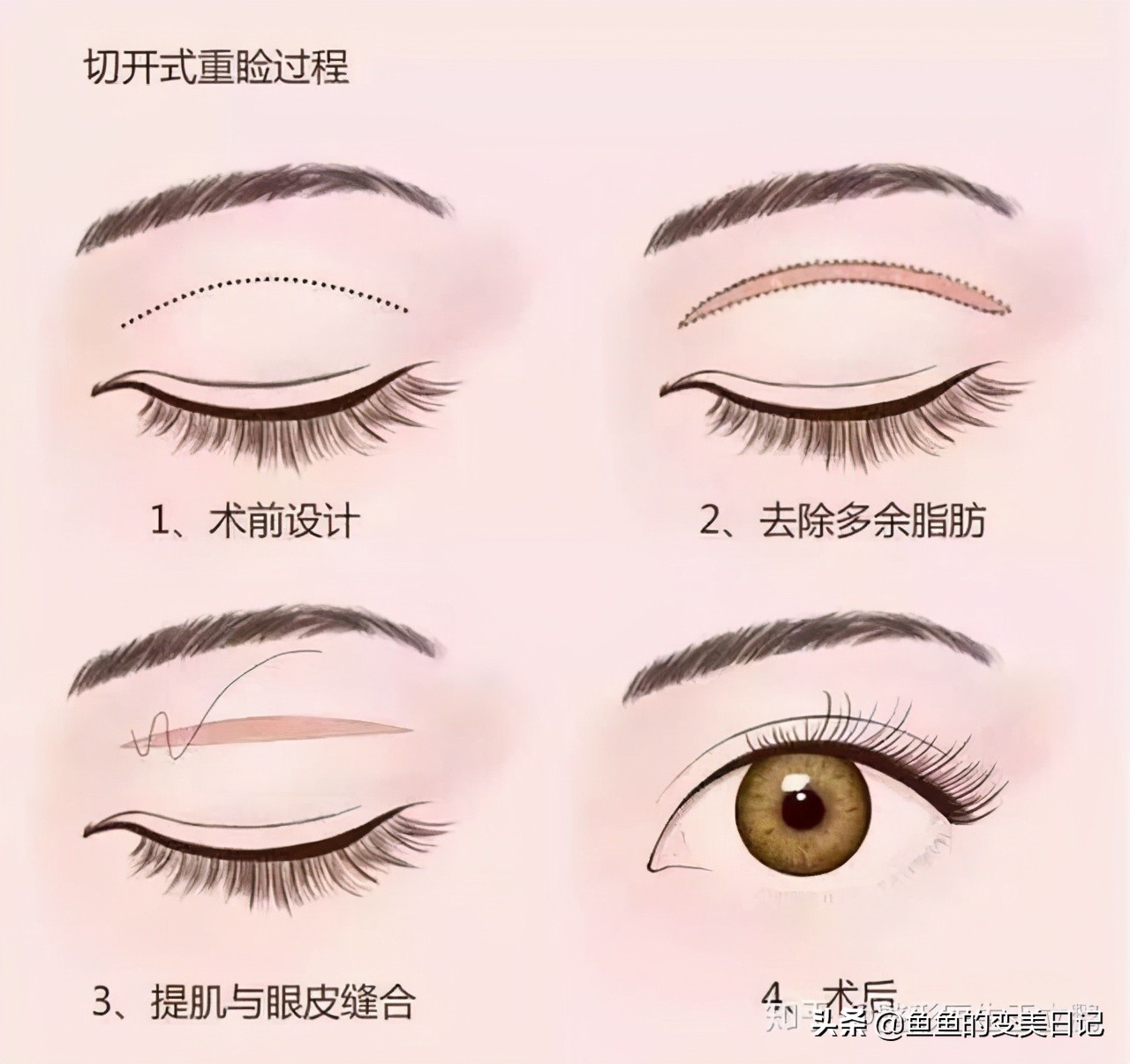 双眼皮知识点总结大全,关于双眼皮的十大真相