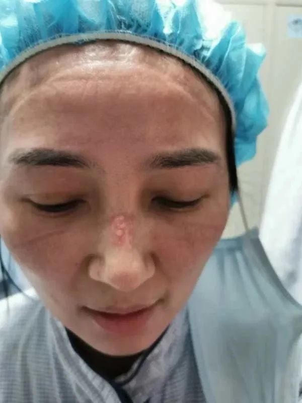 戴口罩脸部有压痕怎么办,戴口罩会皮肤屏障受损吗