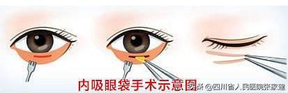 去眼袋手术各种后遗症怎么处理,祛眼袋手术有后遗症吗危险吗