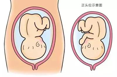 怎样避免顺产侧切,顺产为何都要侧切