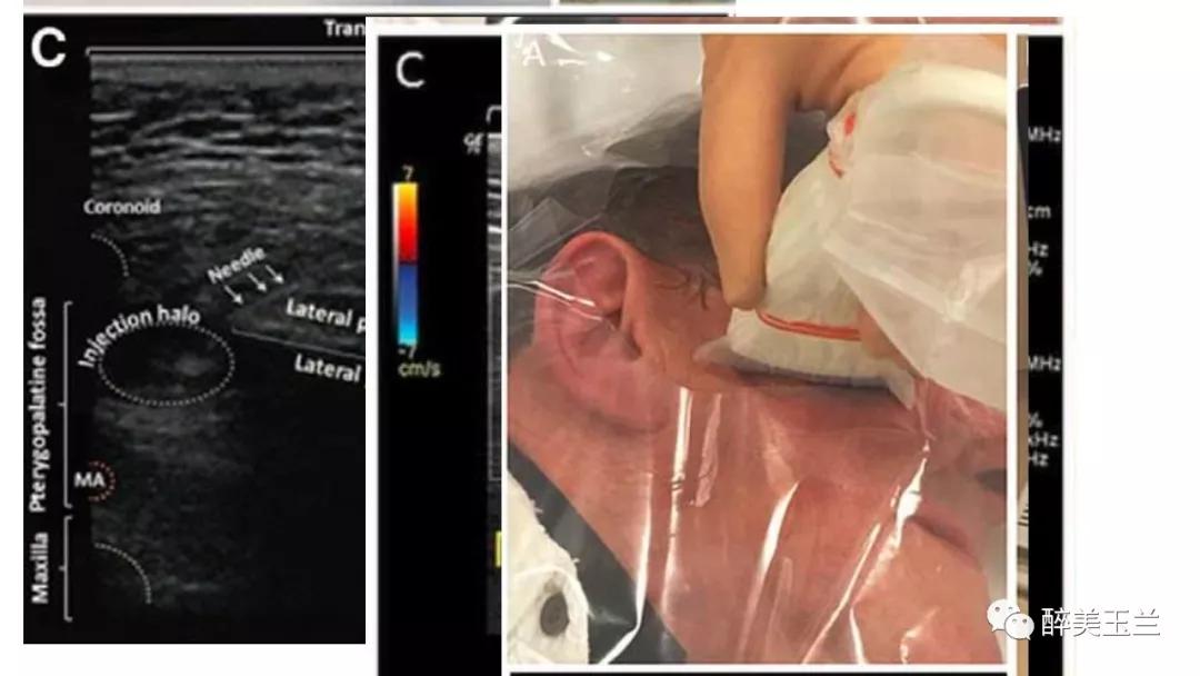 病例分享丨三叉神经节微球囊压迫术的麻醉管理