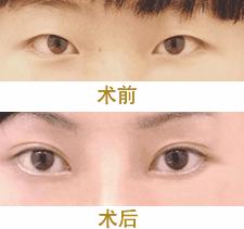 双眼皮埋线优点和缺点,平扇双眼皮优点和缺点