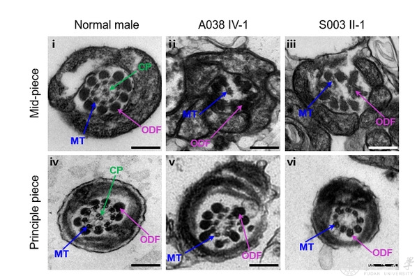 附属妇产科医院张锋课题组合作研究发现人类弱畸精子症的新致病基因TTC29