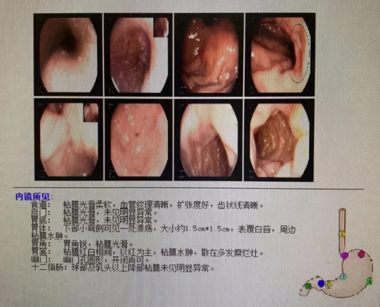 胃体溃疡、糜烂，患者不配合医生治疗，几个月后恶化成早癌