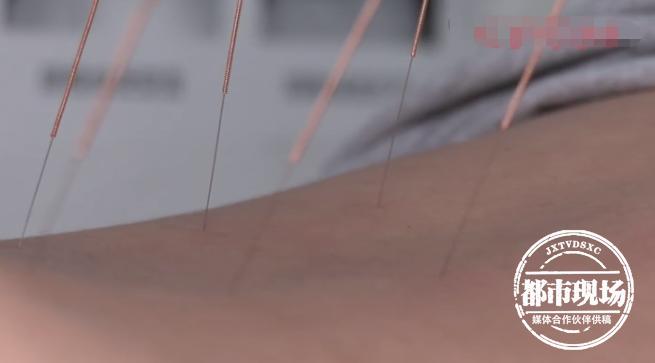 针灸毫针断体内不取出来有事吗,针灸断针取出术