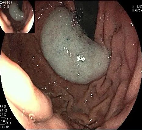 贲门隆起性病变影像,贲门溃疡隆起性病变