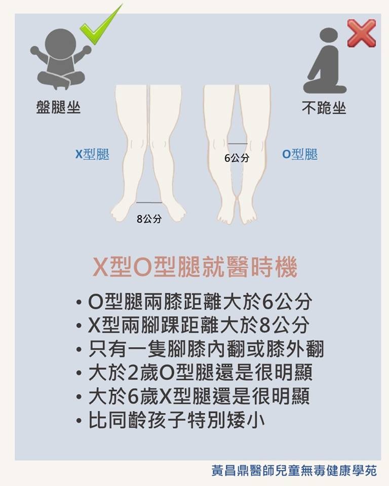 小儿x型腿需要治疗,孩子出现o型腿是缺钙吗