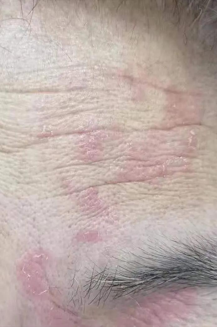 脚气会通过床单传染吗,脚气到底是怎么传染的