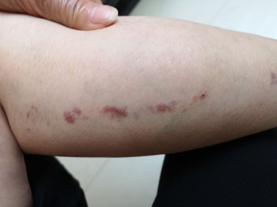 长成圆圈形状是癣还是湿疹,线状苔藓是什么原因造成的