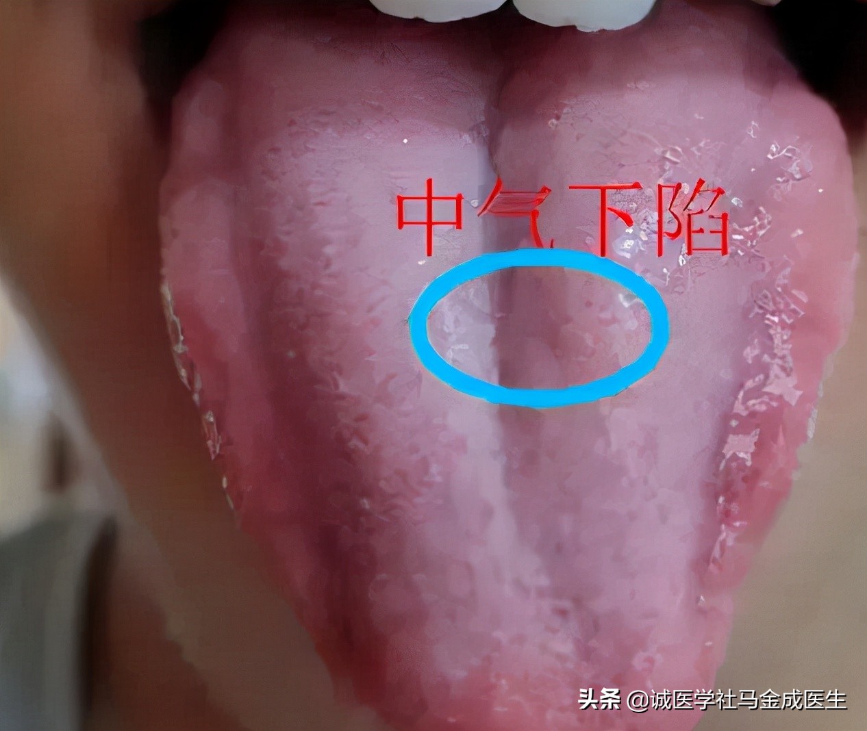 脾虚齿痕舌整天乏困吃什么中成药,治疗脾虚齿痕舌最好的中成药