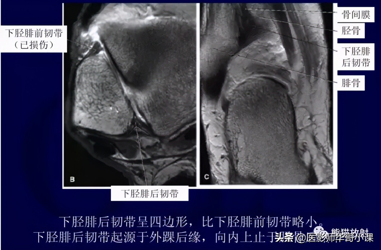 踝关节解剖视频课,解剖学韧带分布图