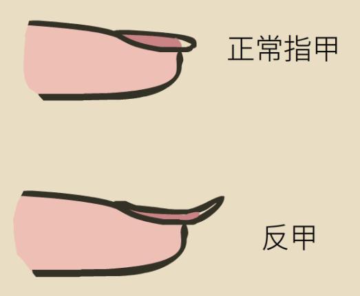 产后指甲出现小坑和凹痕,每个指甲中间都出现一条横凹痕