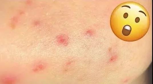 祛痘印小方法和步骤有哪些,痘印肌肤的护肤方法