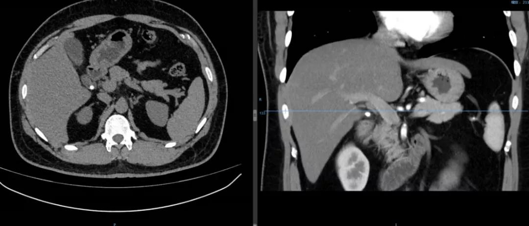 到底是保胆好还是切除好,怎么手术保胆