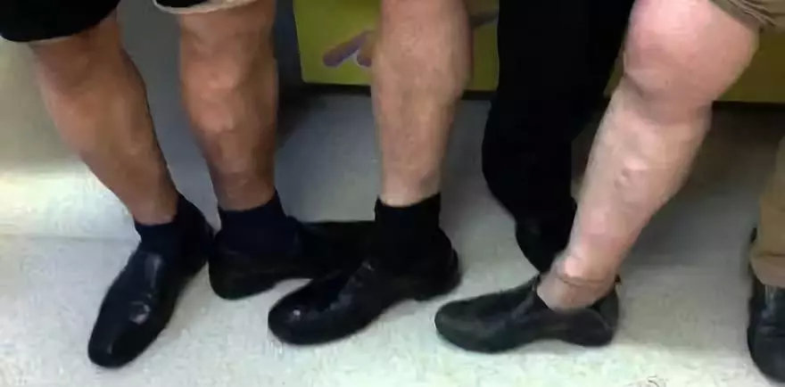 腿上有静脉曲张能生孩子么,妈妈静脉曲张是怎么回事