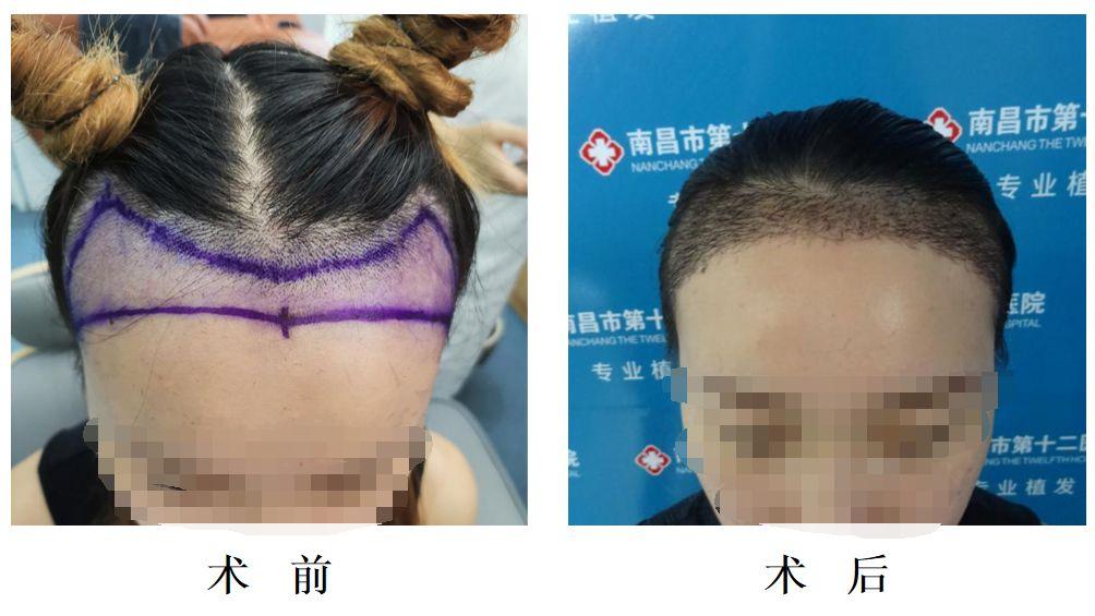 头发种植手术是如何种植的,头发种植利弊有哪些呢