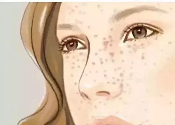 褐斑是什么病,褐青斑是什么原因引起