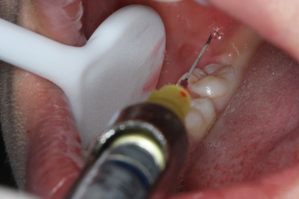 宝宝拔牙还是忍不住吓哭了,宝宝拔牙害怕怎么办