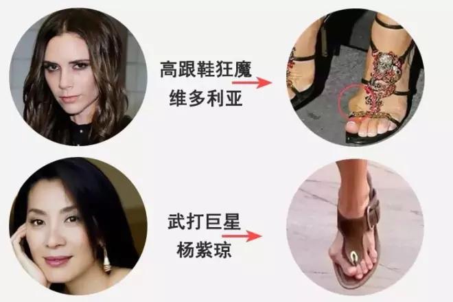 大脚趾拇指外翻矫正用多久,大脚拇指外翻导致第二脚趾弯曲