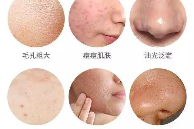 冬天螨虫多还是夏天螨虫多,怎么有效的去除螨虫简单方法