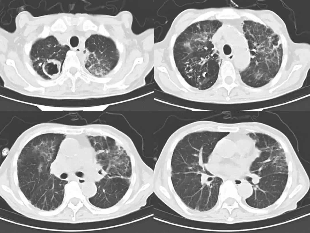 病例分享：无计可施时「黑色的」胸腔积液使治疗找到了方向