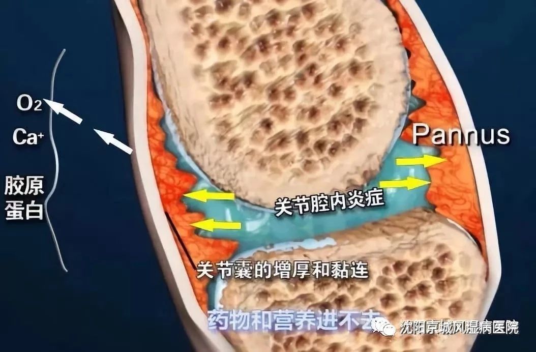 沈阳京城医院治疗类风湿靠谱吗,沈阳京城风湿病医院视频
