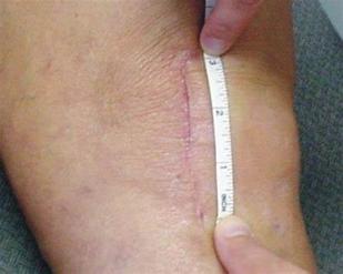 膝关节置换术后伤口渗液,膝关节置换后伤口渗出怎么办