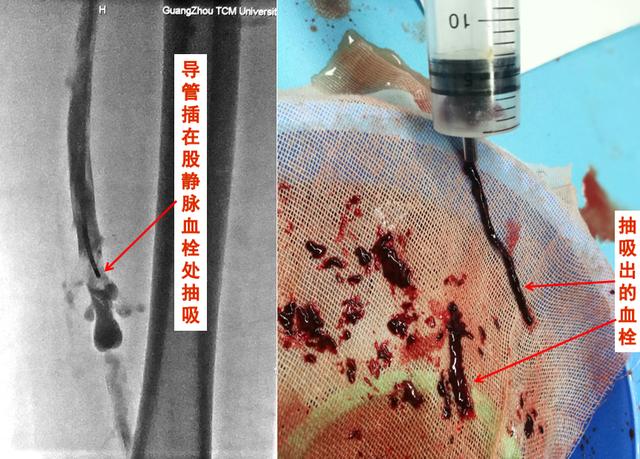 看过来,看过来!静脉曲张与静脉血栓到底有什么区别和联系?