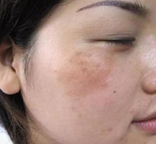 女人脸上有斑吃什么药可以祛斑,脸上长斑吃什么中药调理祛斑