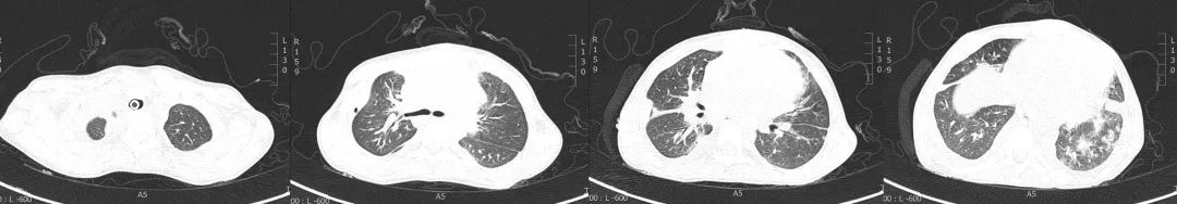 不敢咳嗽如何进行有效排痰,无咳嗽呼吸困难